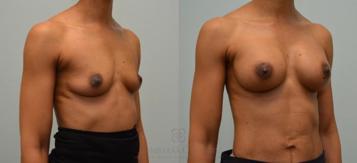 Before & After Breast Augmentation Case 149 View #2 View in Houston, TX