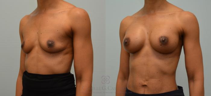 Before & After Breast Augmentation Case 149 View #3 View in Houston, TX