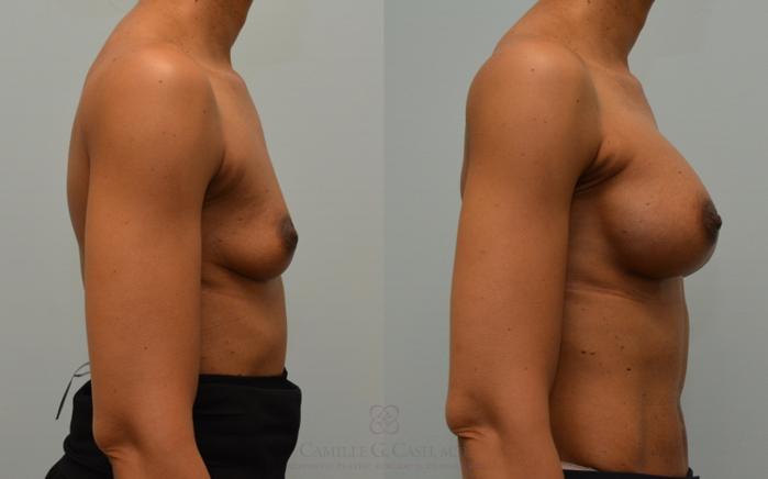 Before & After Breast Augmentation Case 149 View #4 View in Houston, TX