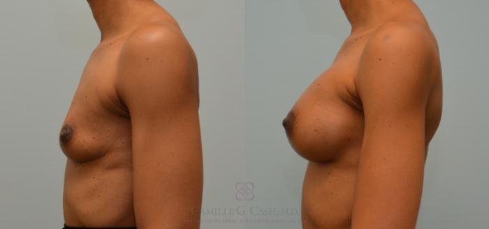 Before & After Breast Augmentation Case 149 View #5 View in Houston, TX