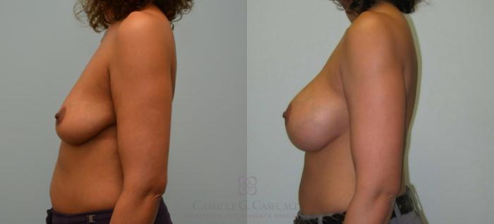 Before & After Breast Augmentation Case 151 View #3 View in Houston, TX