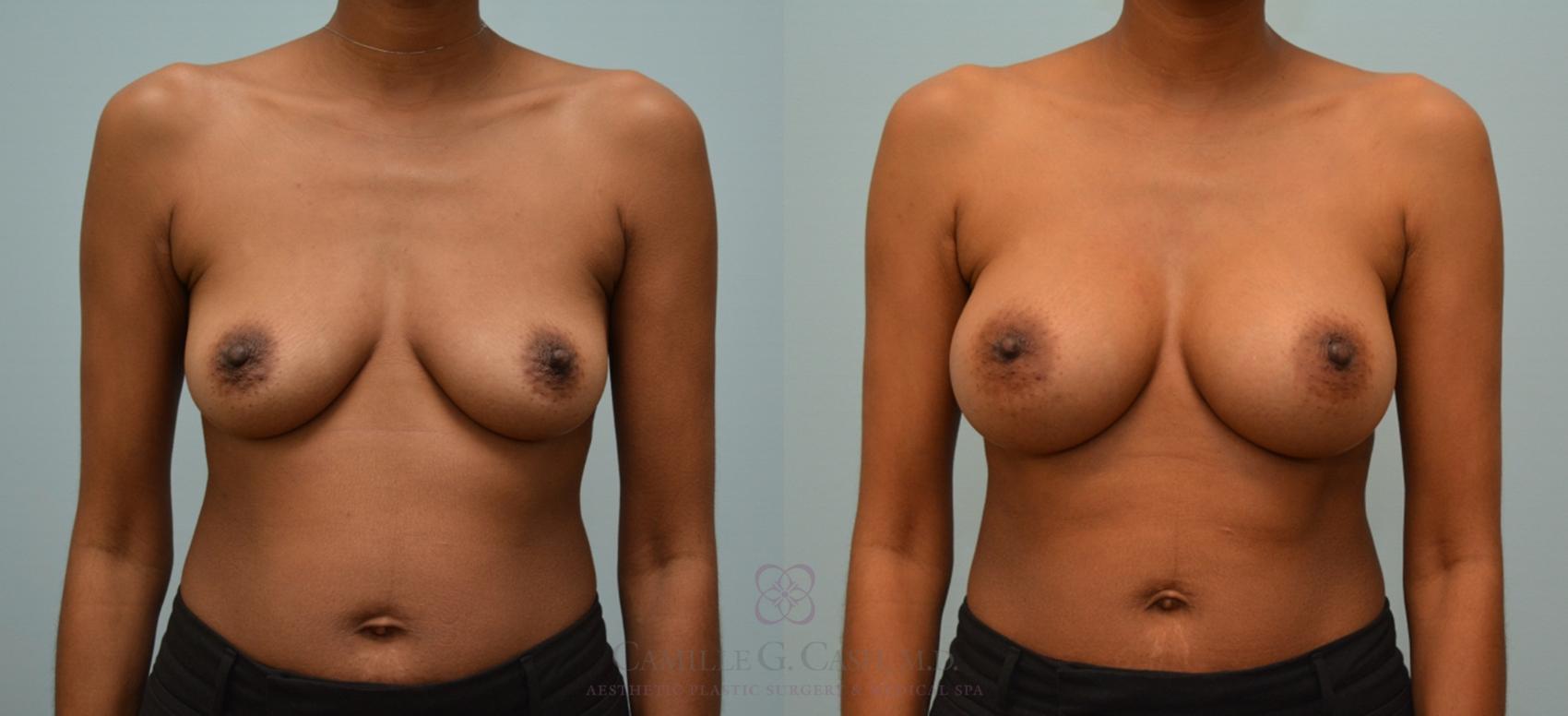 Before & After Breast Augmentation Case 162 View #1 View in Houston, TX