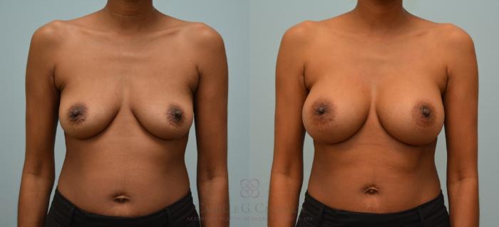 Before & After Breast Augmentation Case 162 View #1 View in Houston, TX