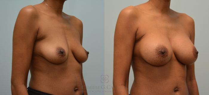 Before & After Breast Augmentation Case 162 View #3 View in Houston, TX