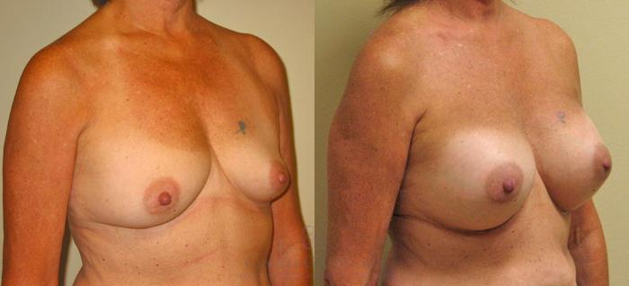 Before & After Breast Augmentation Case 164 View #1 View in Houston, TX