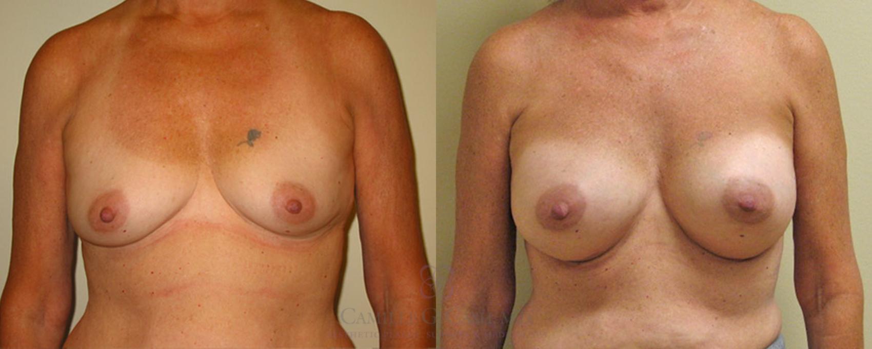 Before & After Breast Augmentation Case 164 View #2 View in Houston, TX