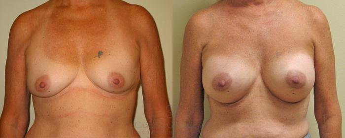 Before & After Breast Augmentation Case 164 View #2 View in Houston, TX