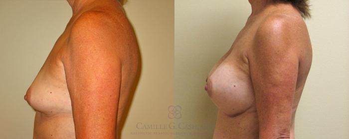 Before & After Breast Augmentation Case 164 View #3 View in Houston, TX