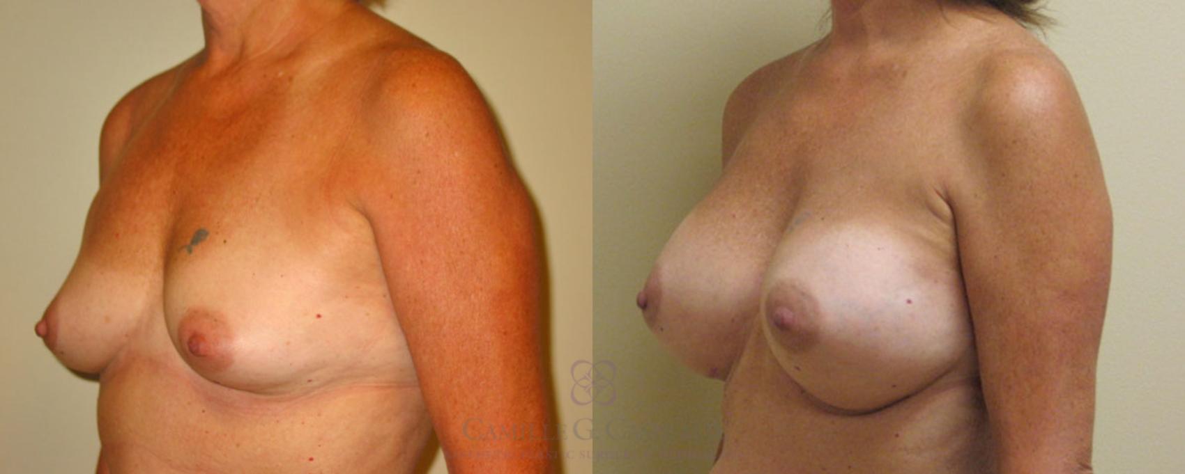 Before & After Breast Augmentation Case 164 View #4 View in Houston, TX