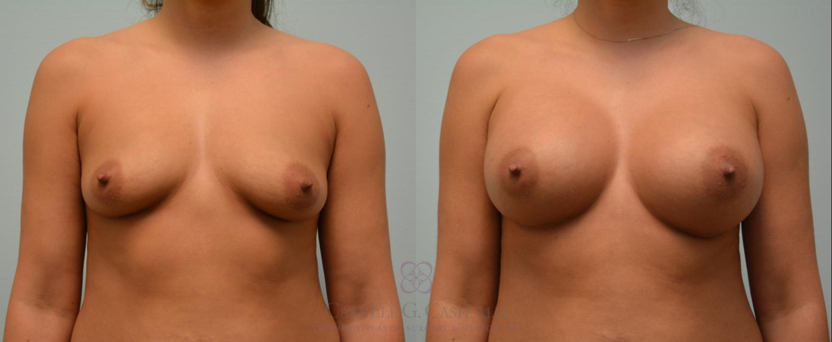 Before & After Breast Augmentation Case 165 View #1 View in Houston, TX