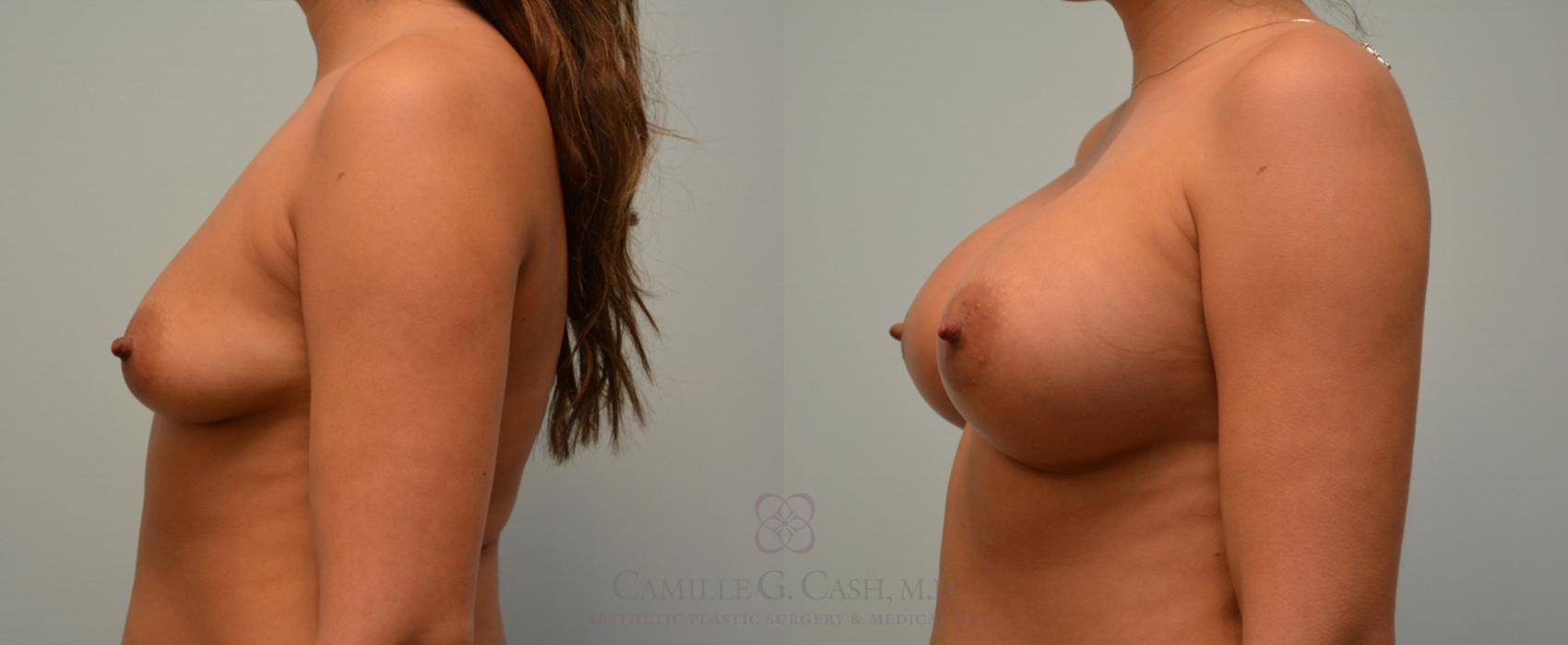 Before & After Breast Augmentation Case 165 View #2 View in Houston, TX