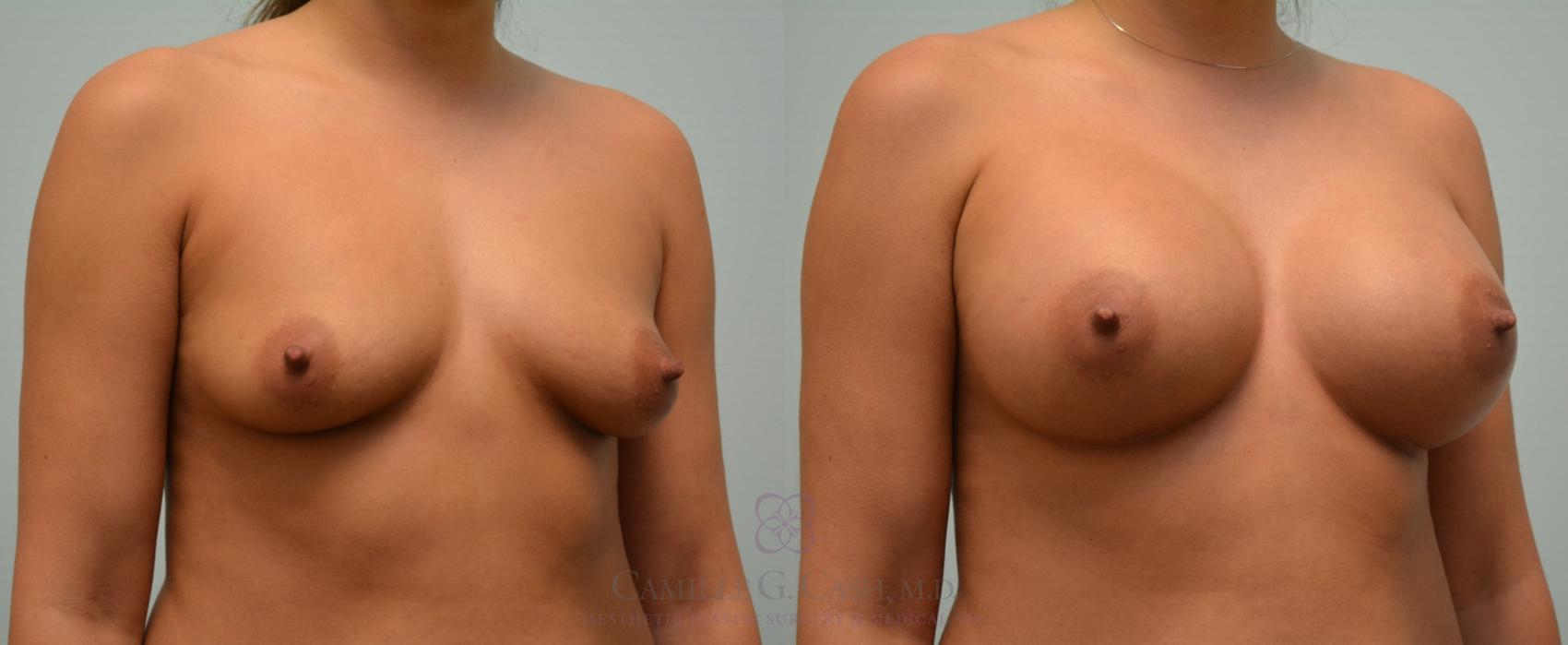 Before & After Breast Augmentation Case 165 View #3 View in Houston, TX