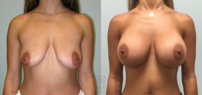 Before & After Breast Augmentation Case 166 View #1 View in Houston, TX