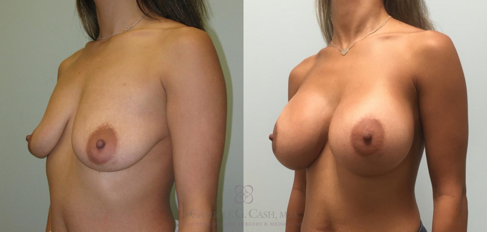 Before & After Breast Augmentation Case 166 View #2 View in Houston, TX