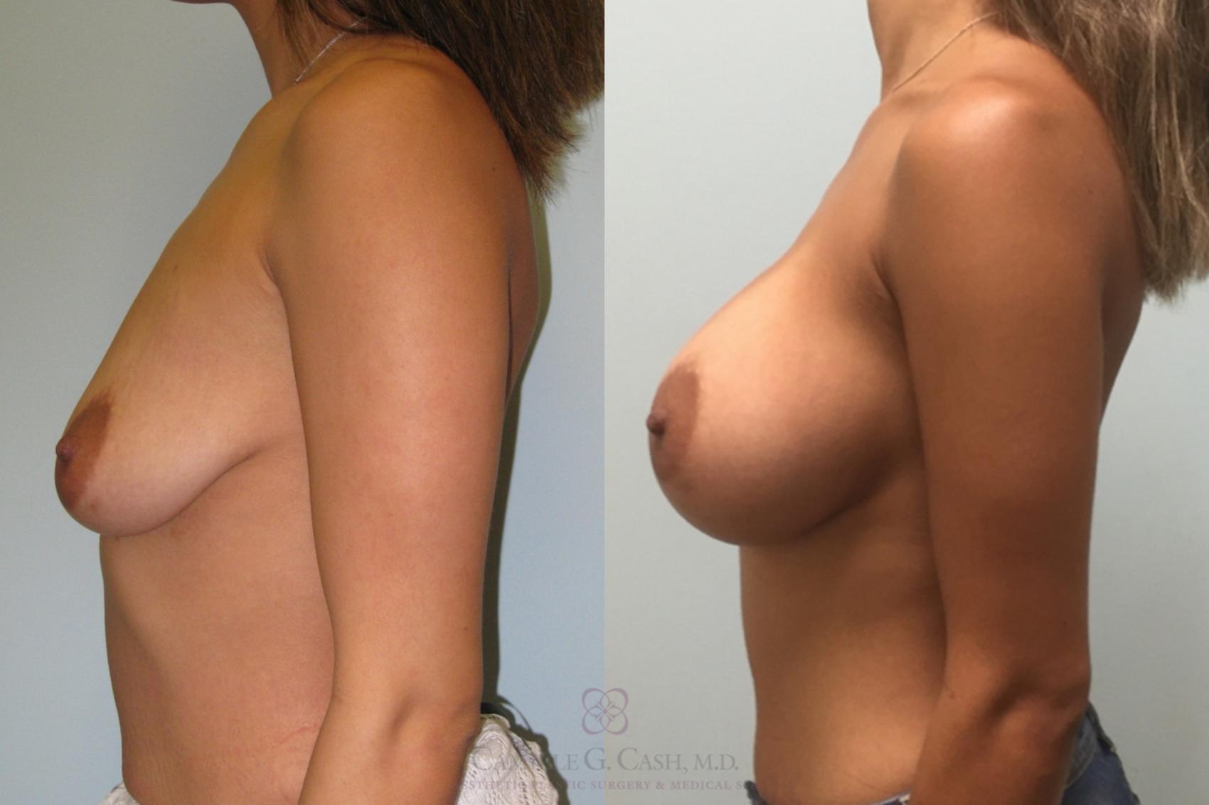 Before & After Breast Augmentation Case 166 View #3 View in Houston, TX