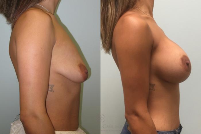 Before & After Breast Augmentation Case 166 View #4 View in Houston, TX