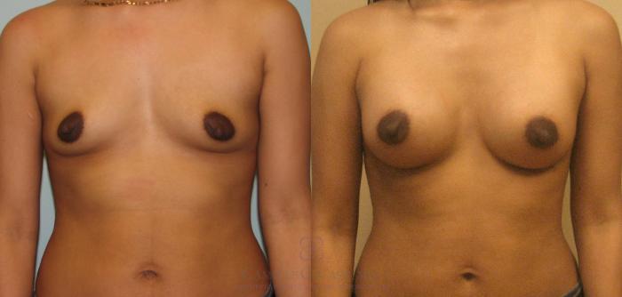 Before & After Breast Augmentation Case 167 View #2 View in Houston, TX