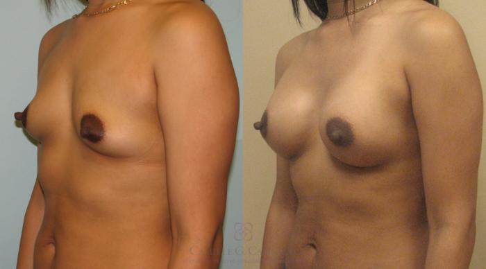 Before & After Breast Augmentation Case 167 View #3 View in Houston, TX