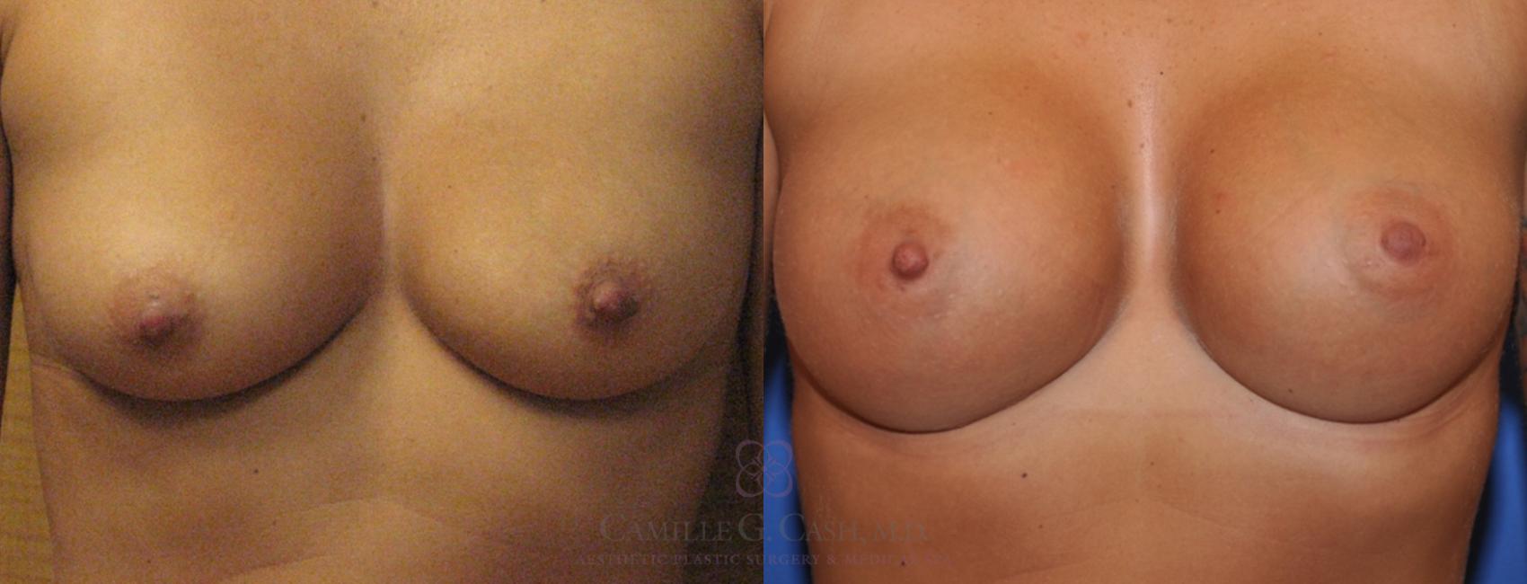 Before & After Breast Augmentation Case 171 View #1 View in Houston, TX