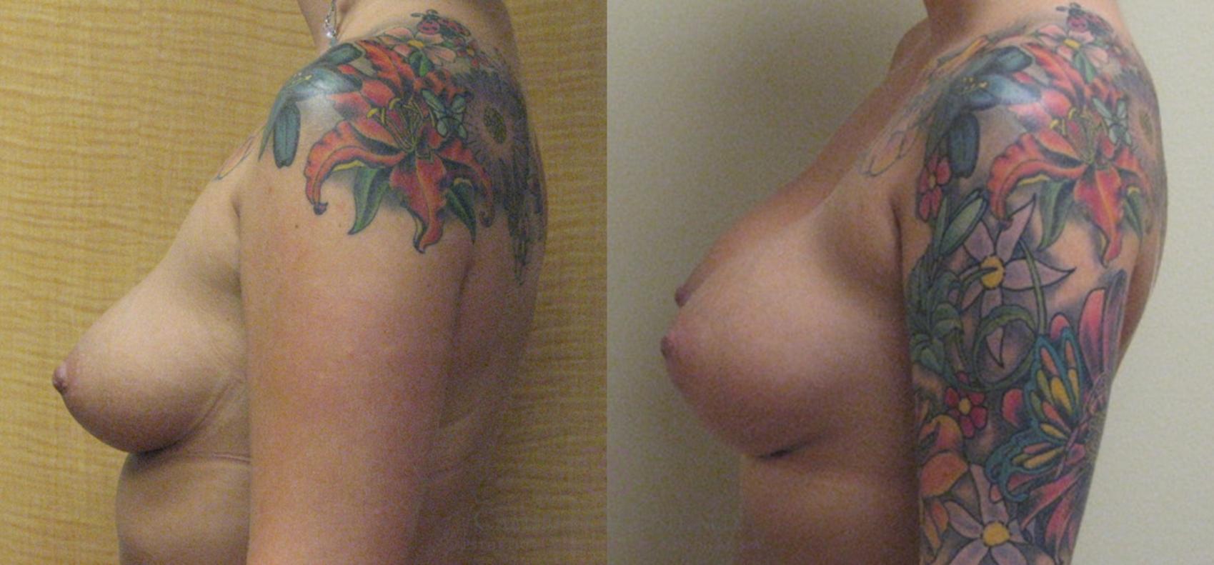 Before & After Breast Augmentation Case 171 View #4 View in Houston, TX