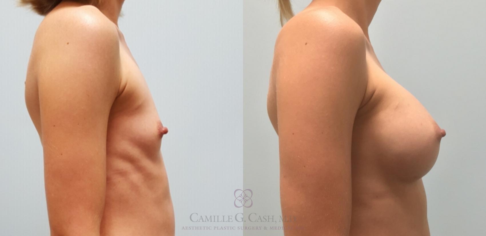 Before & After Breast Augmentation Case 174 View #2 View in Houston, TX
