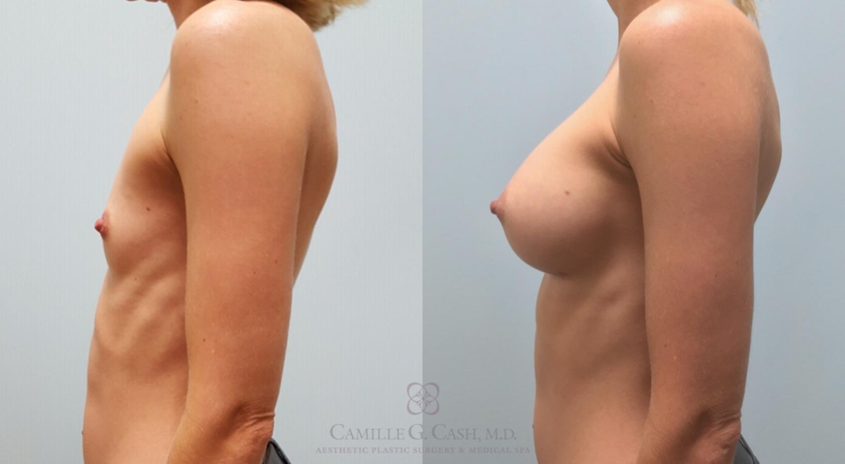 Before & After Breast Augmentation Case 174 View #3 View in Houston, TX