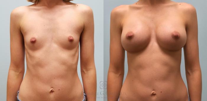 Before & After Breast Augmentation Case 174 View #4 View in Houston, TX