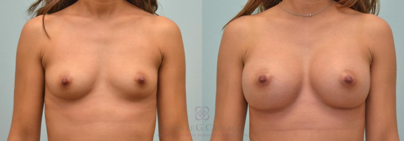 Before & After Breast Augmentation Case 176 View #1 View in Houston, TX