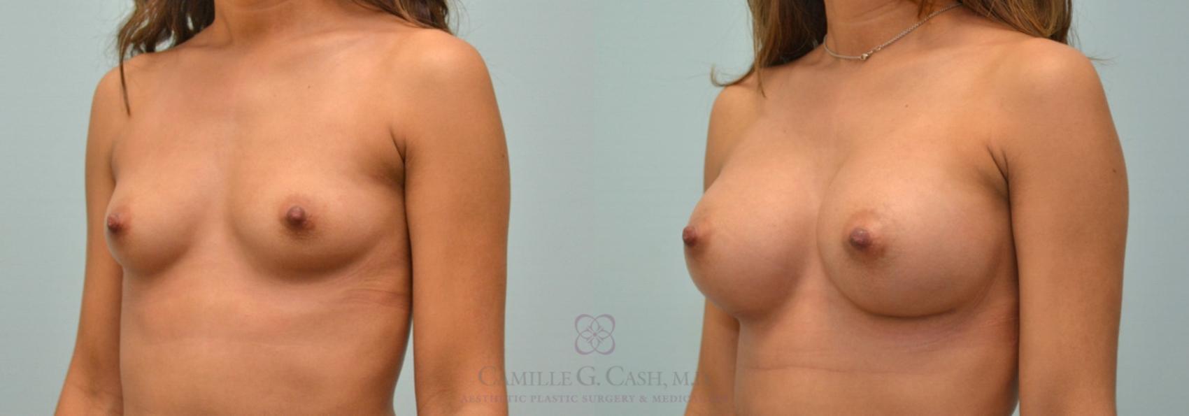 Before & After Breast Augmentation Case 176 View #2 View in Houston, TX