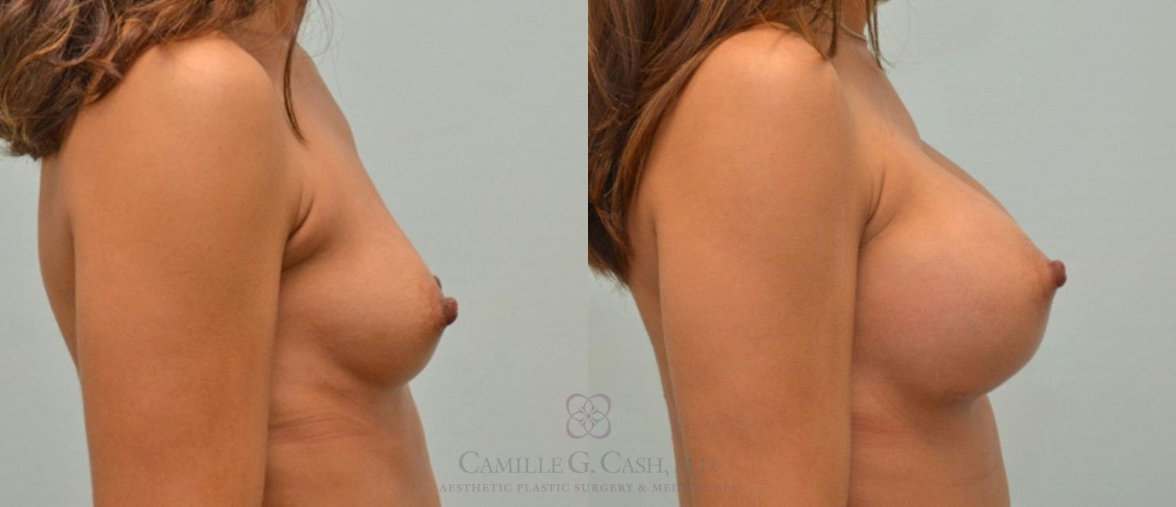 Before & After Breast Augmentation Case 176 View #3 View in Houston, TX