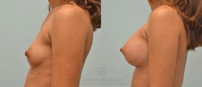 Before & After Breast Augmentation Case 176 View #4 View in Houston, TX