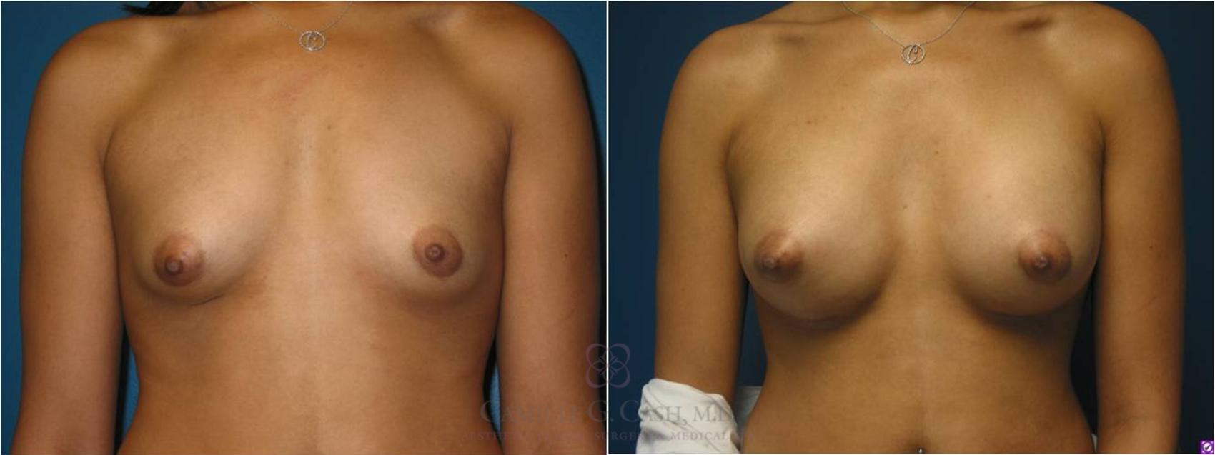 Before & After Breast Augmentation Case 19 View #3 View in Houston, TX