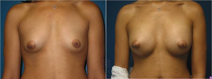 Before & After Breast Augmentation Case 19 View #3 View in Houston, TX