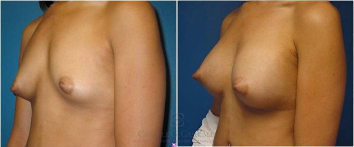Before & After Breast Augmentation Case 19 View #5 View in Houston, TX
