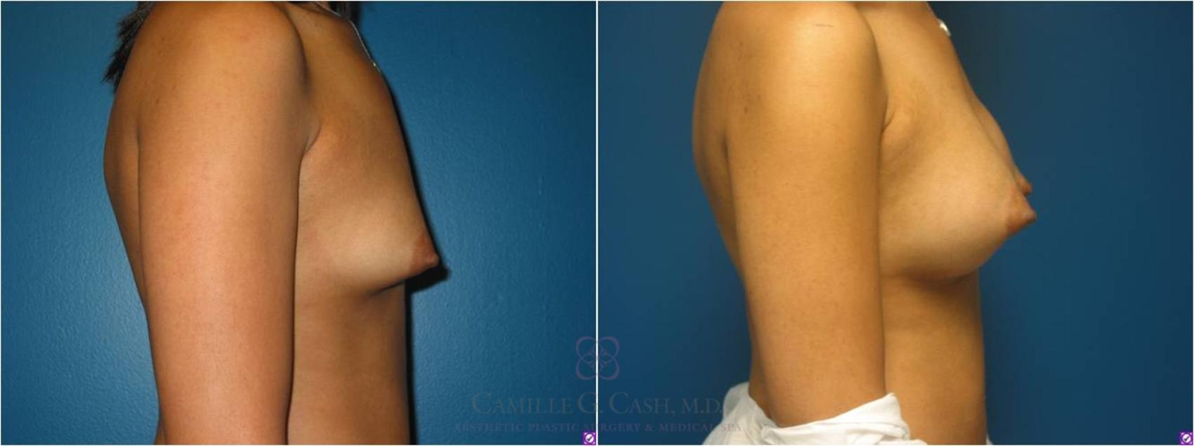 Before & After Breast Augmentation Case 19 View #7 View in Houston, TX