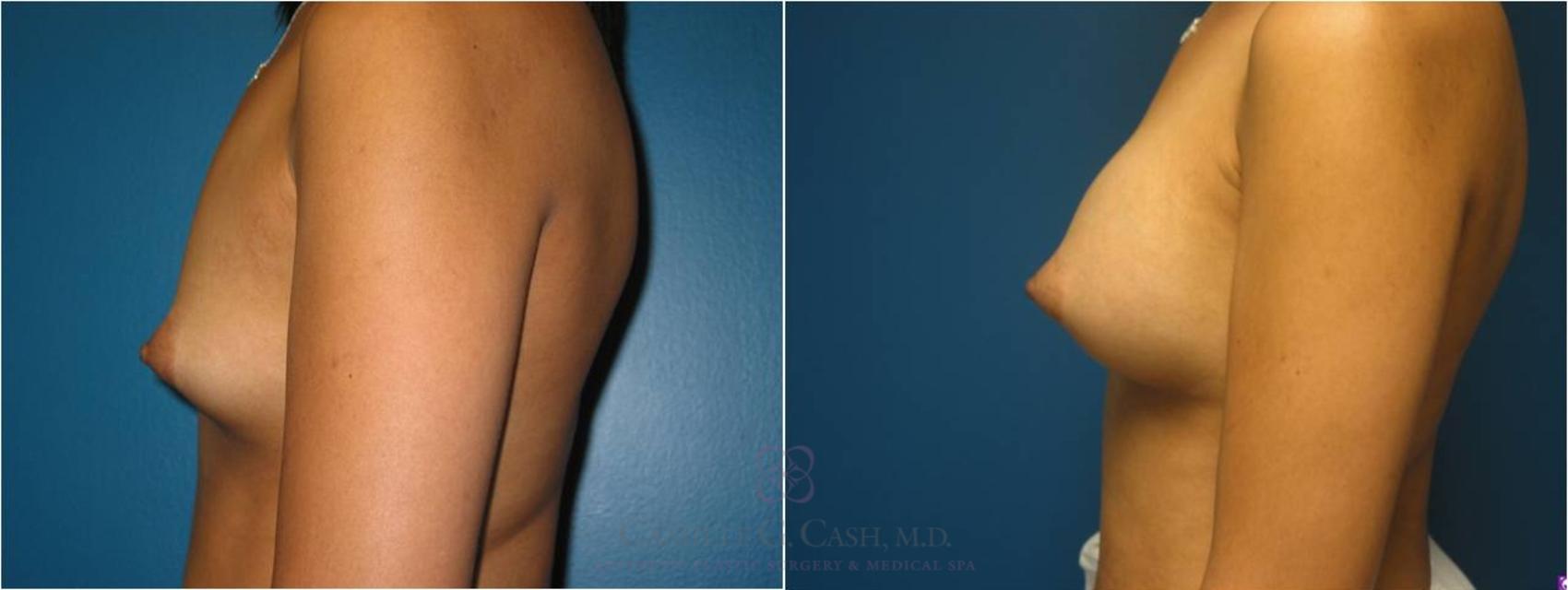 Before & After Breast Augmentation Case 19 View #8 View in Houston, TX