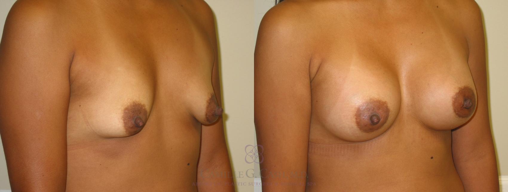 Before & After Breast Augmentation Case 194 View #2 View in Houston, TX