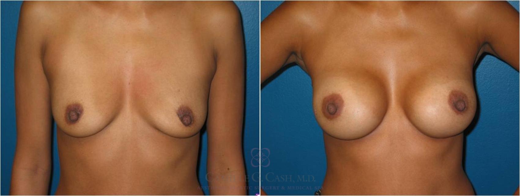 Before & After Breast Augmentation Case 22 View #2 View in Houston, TX