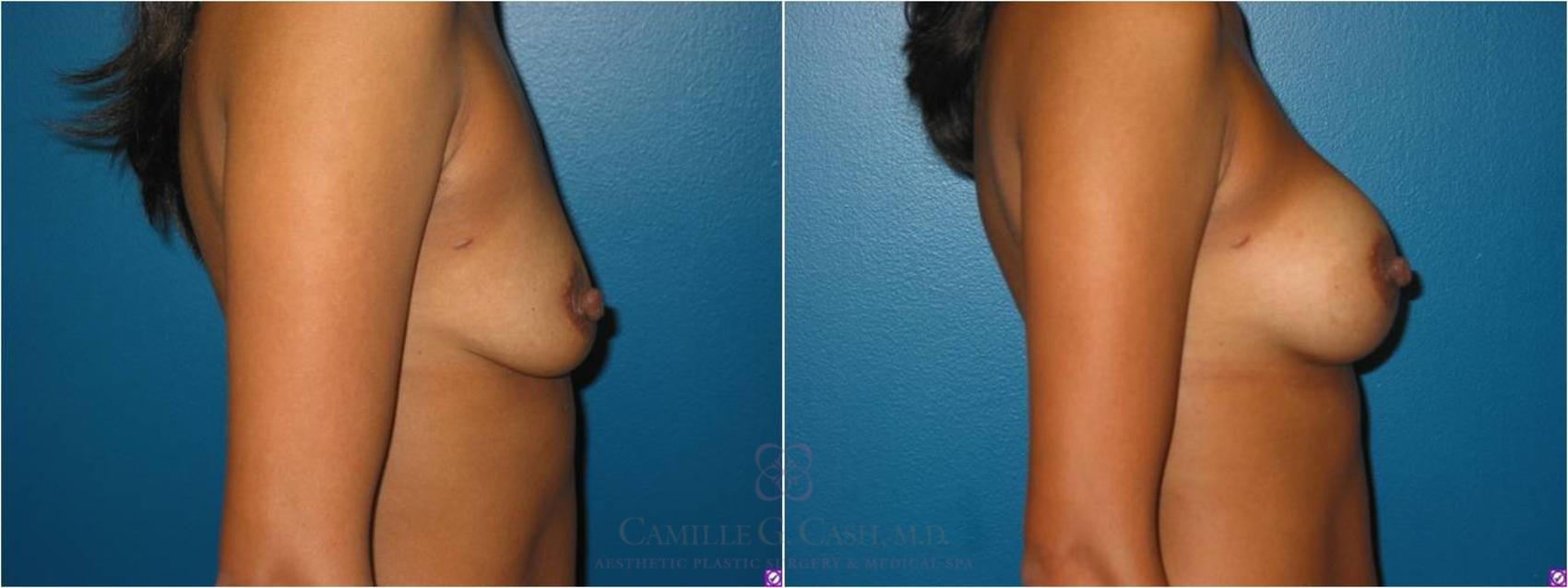 Before & After Breast Augmentation Case 22 View #3 View in Houston, TX