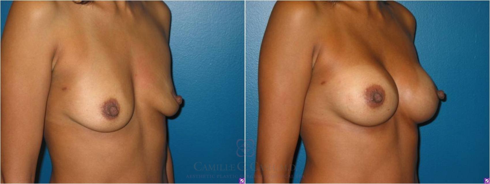 Before & After Breast Augmentation Case 22 View #4 View in Houston, TX