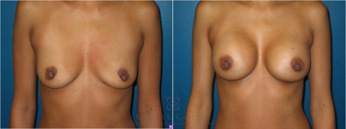 Before & After Breast Augmentation Case 22 View #5 View in Houston, TX