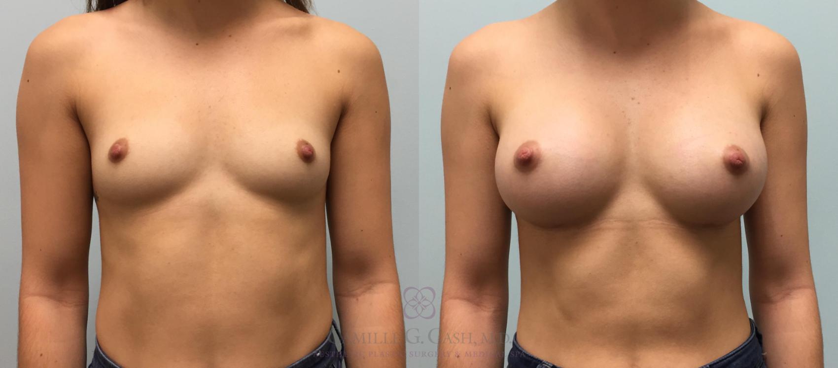 Before & After Breast Augmentation Case 220 View #1 View in Houston, TX