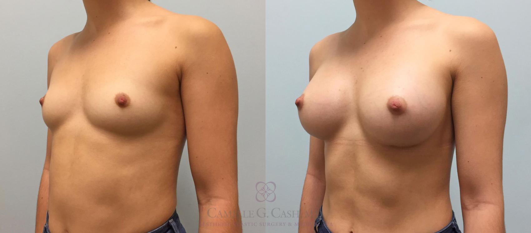 Before & After Breast Augmentation Case 220 View #2 View in Houston, TX