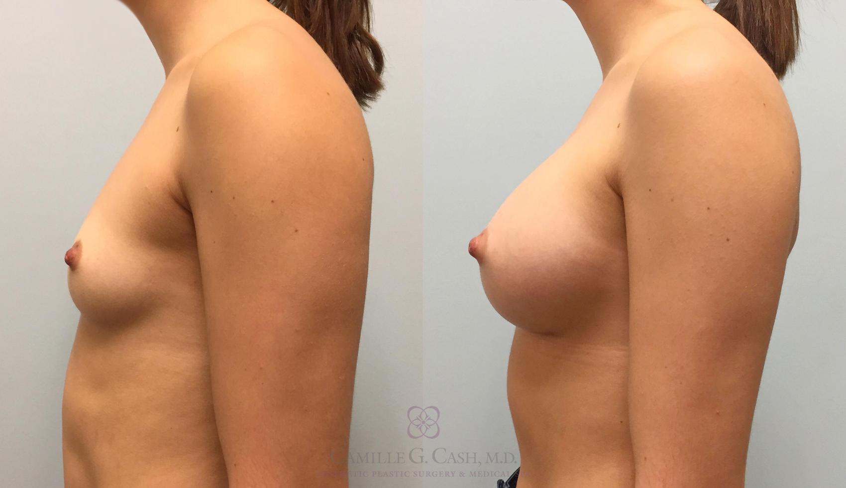 Before & After Breast Augmentation Case 220 View #3 View in Houston, TX