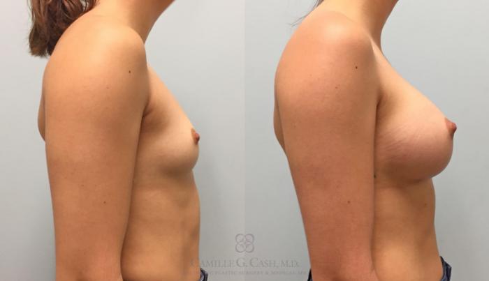 Before & After Breast Augmentation Case 220 View #4 View in Houston, TX