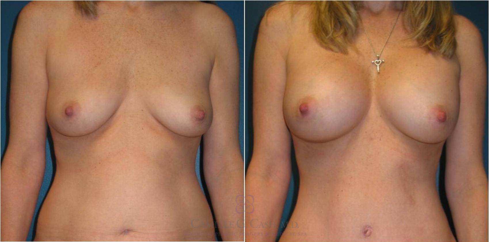 Before & After Breast Augmentation Case 23 View #1 View in Houston, TX