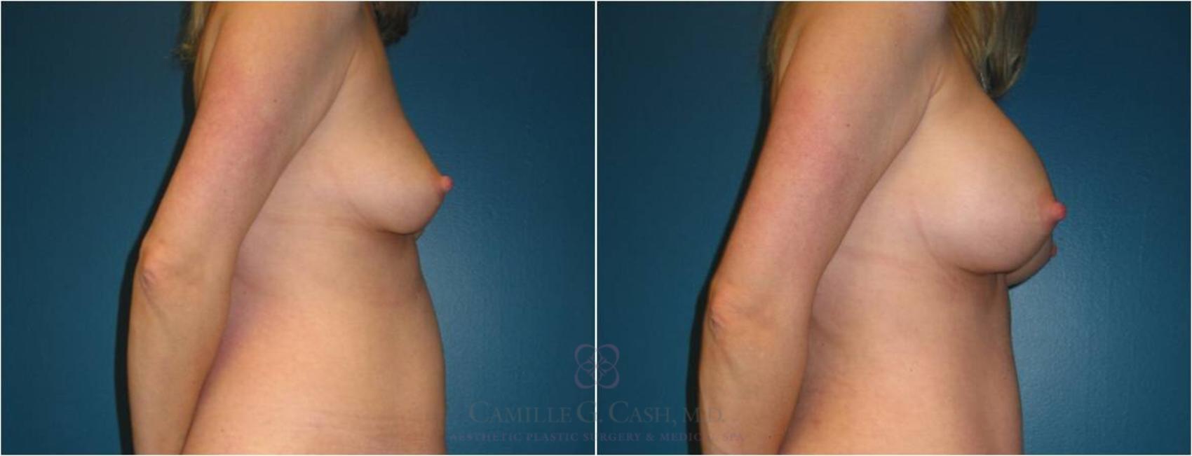 Before & After Breast Augmentation Case 23 View #4 View in Houston, TX