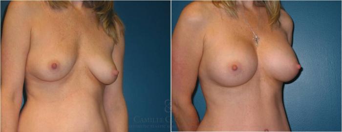Before & After Breast Augmentation Case 23 View #5 View in Houston, TX