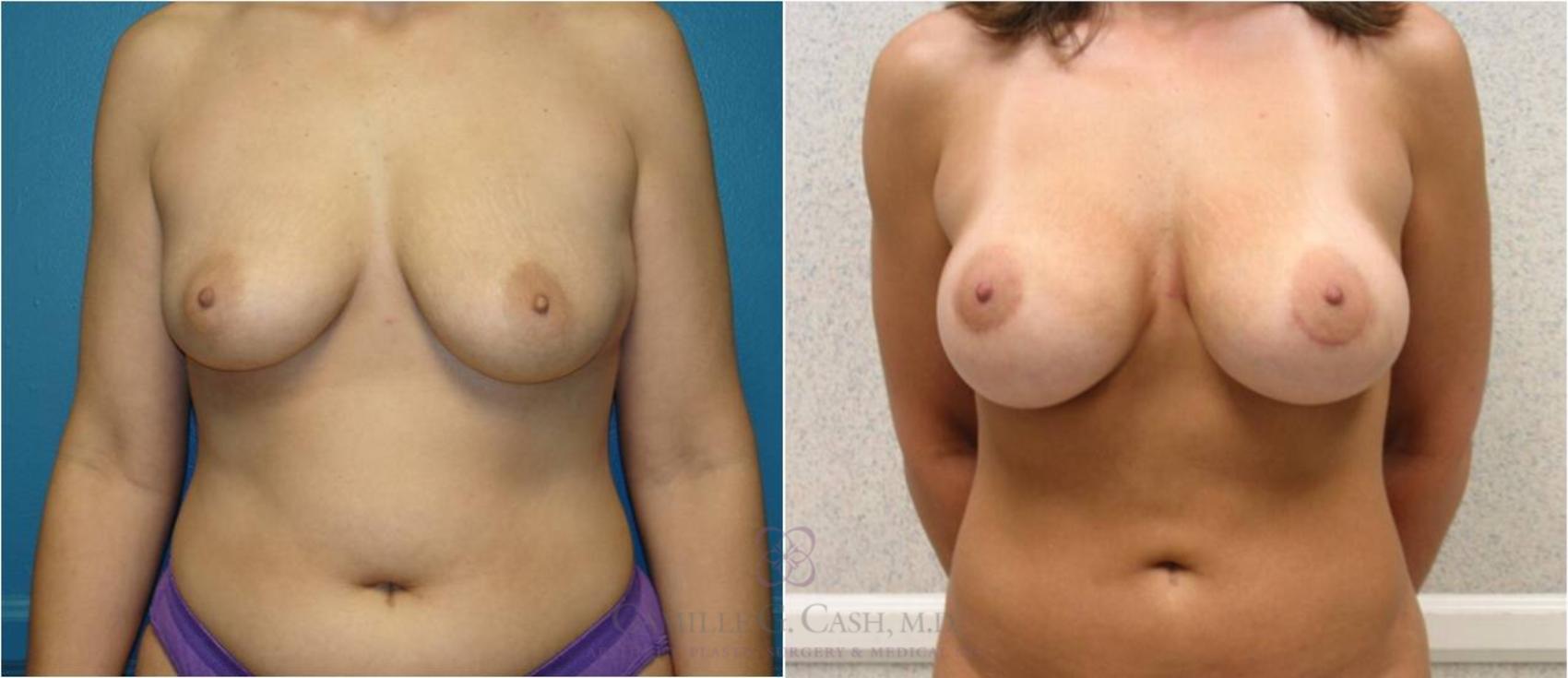 Before & After Breast Augmentation Case 24 View #4 View in Houston, TX