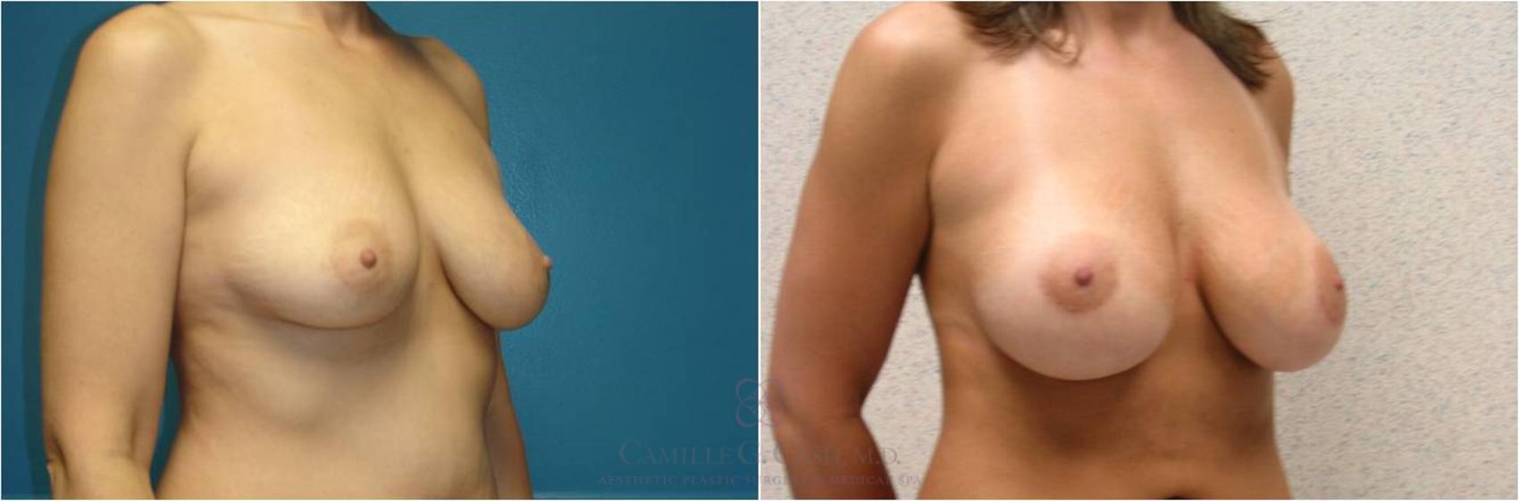 Before & After Breast Augmentation Case 24 View #5 View in Houston, TX